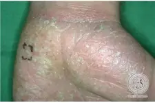 Püstüler Psoriasis Belirtileri ve Tedavisi