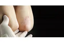 Çocuklarda Sedef Hastalığı Belirtileri ve Tedavisi