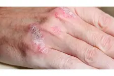 Sedef Hastalığı Nasıl Geçer?