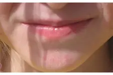 Yüzde Sedef Hastalığı Belirtileri ve Tedavisi